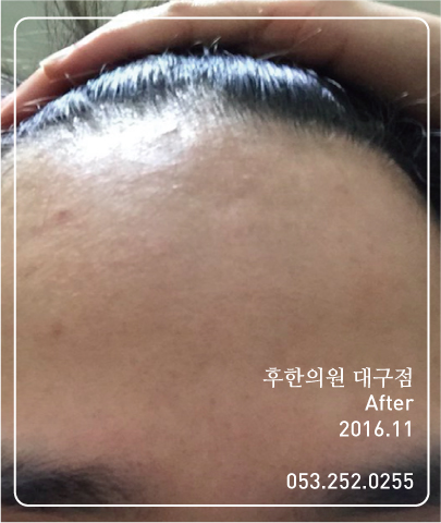 치료 후