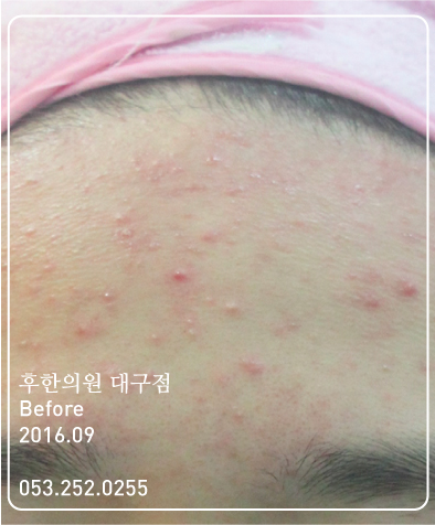 치료 전