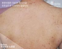 치료 전