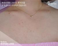 치료 전