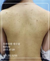 치료 전