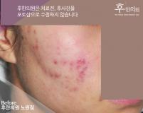 치료 전