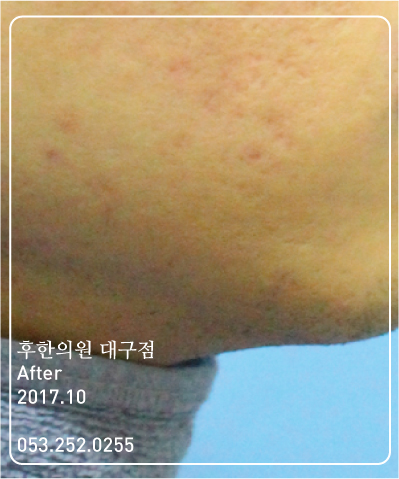 치료 후