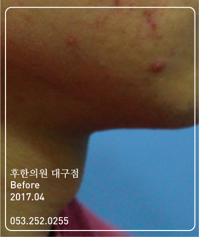 치료 전