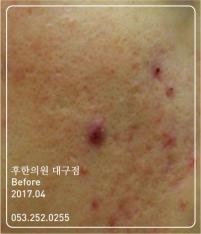 치료 전