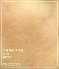 치료 후