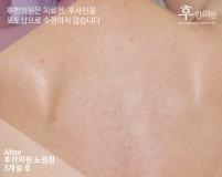 치료 후