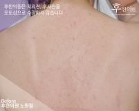 치료 전