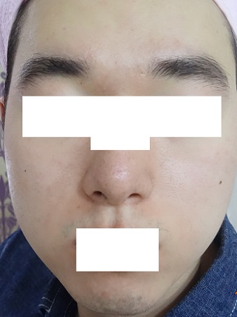 치료 후