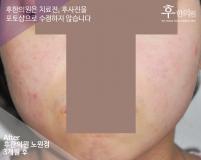 치료 후