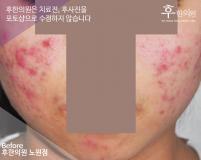 치료 전