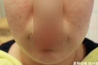 치료 후
