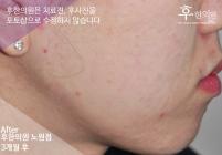 치료 후