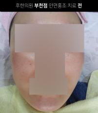 치료 전