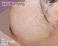 치료 후