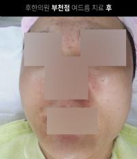 치료 후