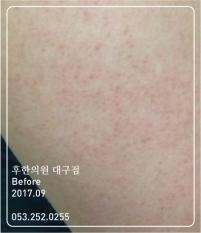 치료 전