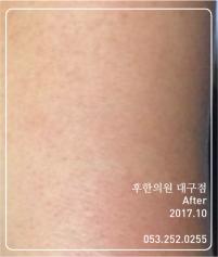치료 후