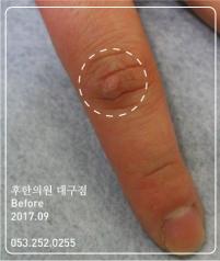 치료 전