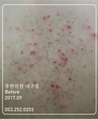 치료 전