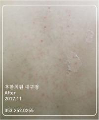 치료 후