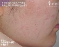 치료 후