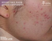 치료 전