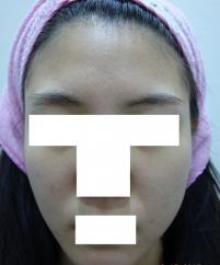 치료 후