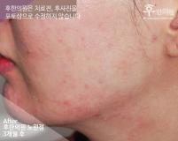 치료 후