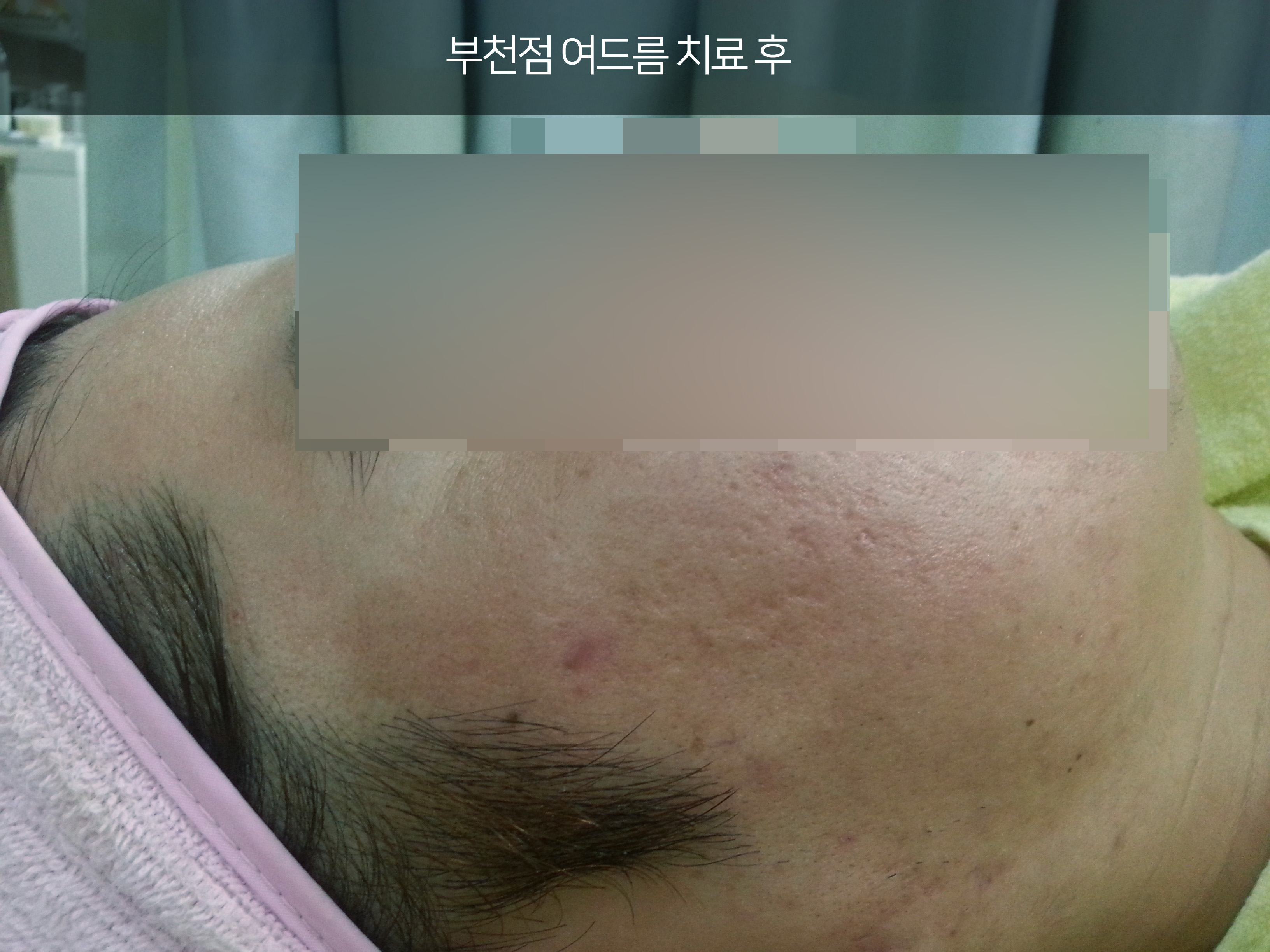 치료 후