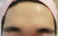 치료 후