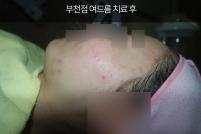 치료 후