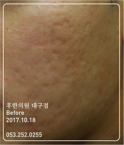 치료 전