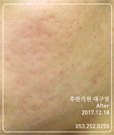 치료 후