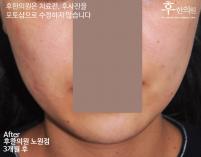 치료 후