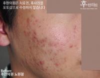 치료 전
