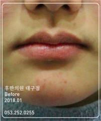 치료 전