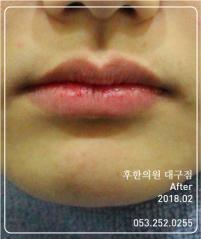치료 후