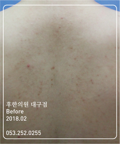 치료 전