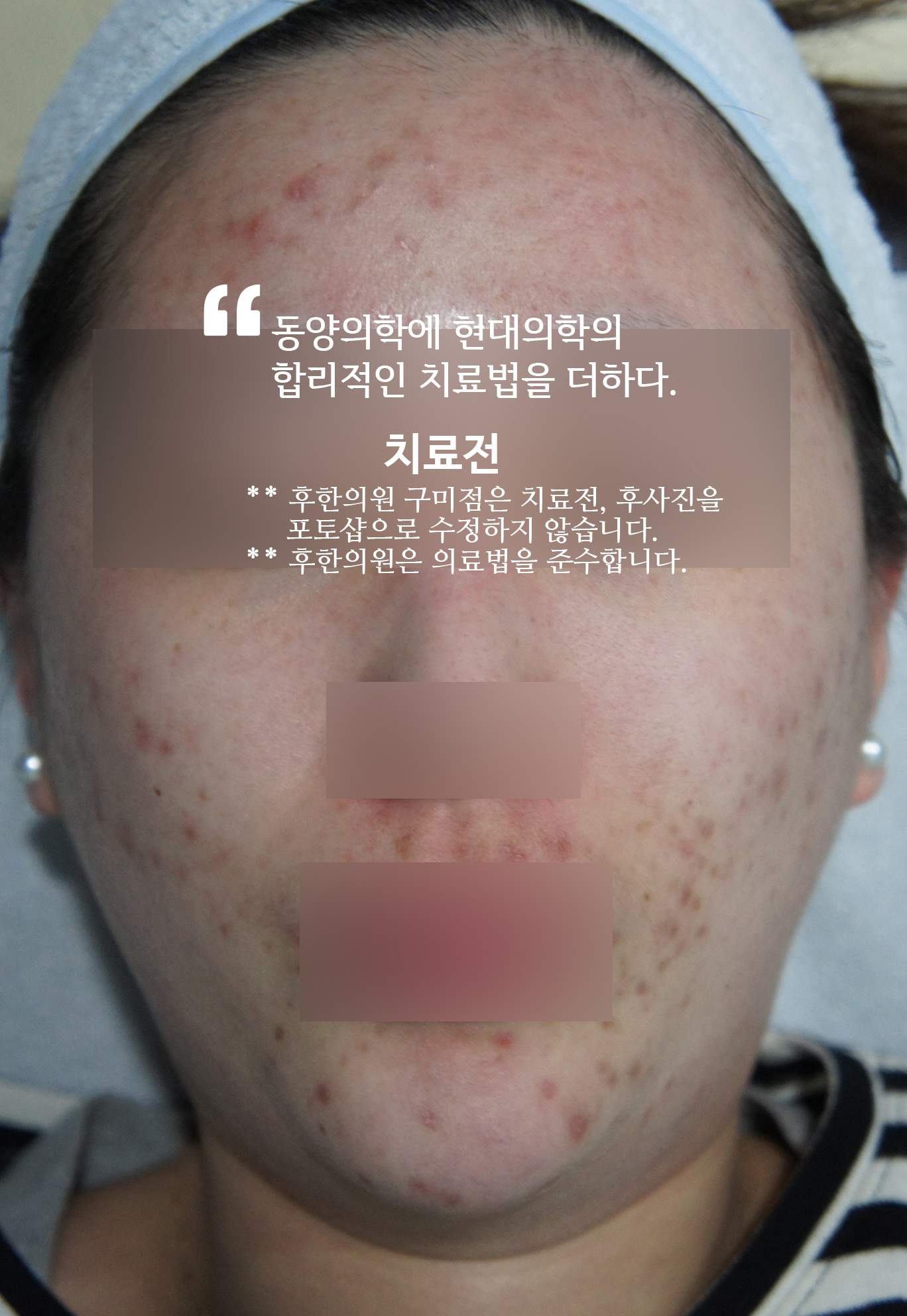 치료 전