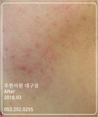 치료 후