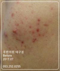 치료 전