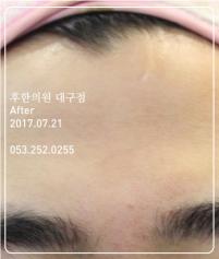 치료 후