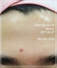 치료 전