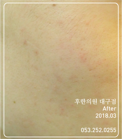 치료 후
