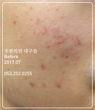 치료 전