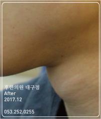 치료 후