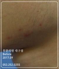 치료 전