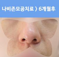 치료 후