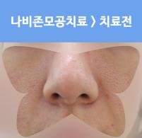 치료 전